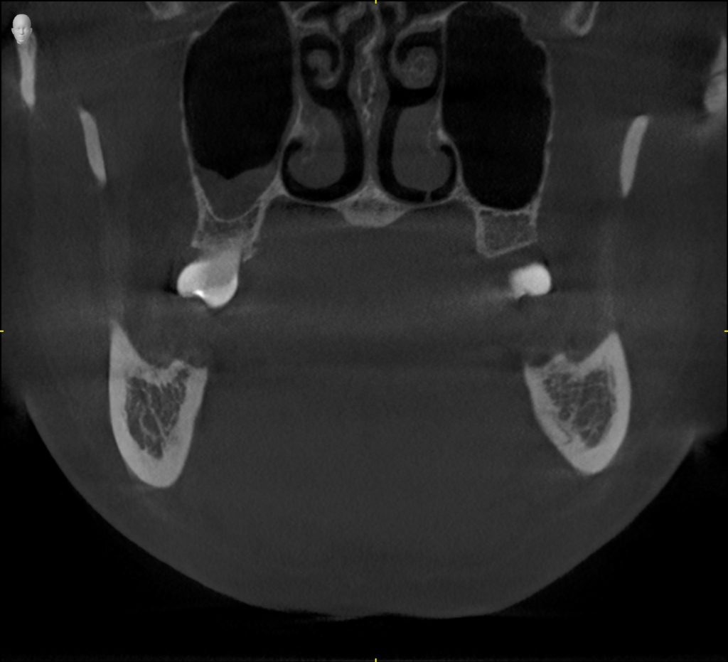 3D Coronal (from the front) Image - Preferred Dental