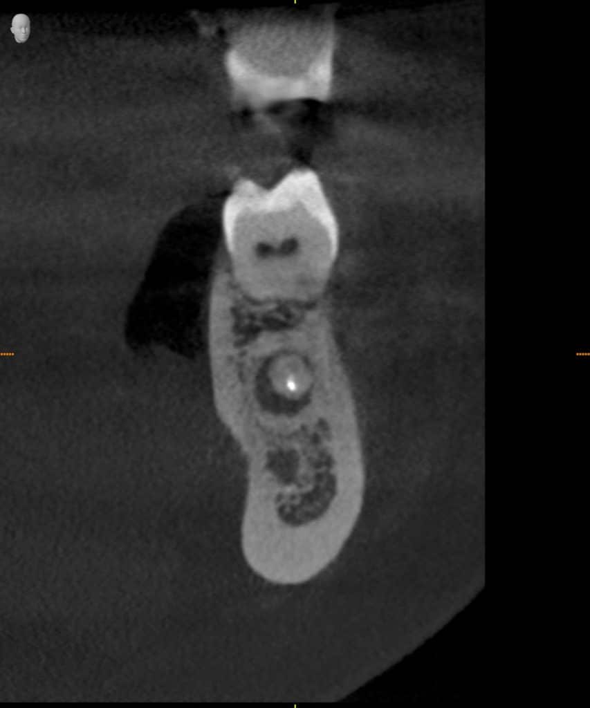 3D Cross Sectional Image - Preferred Dental