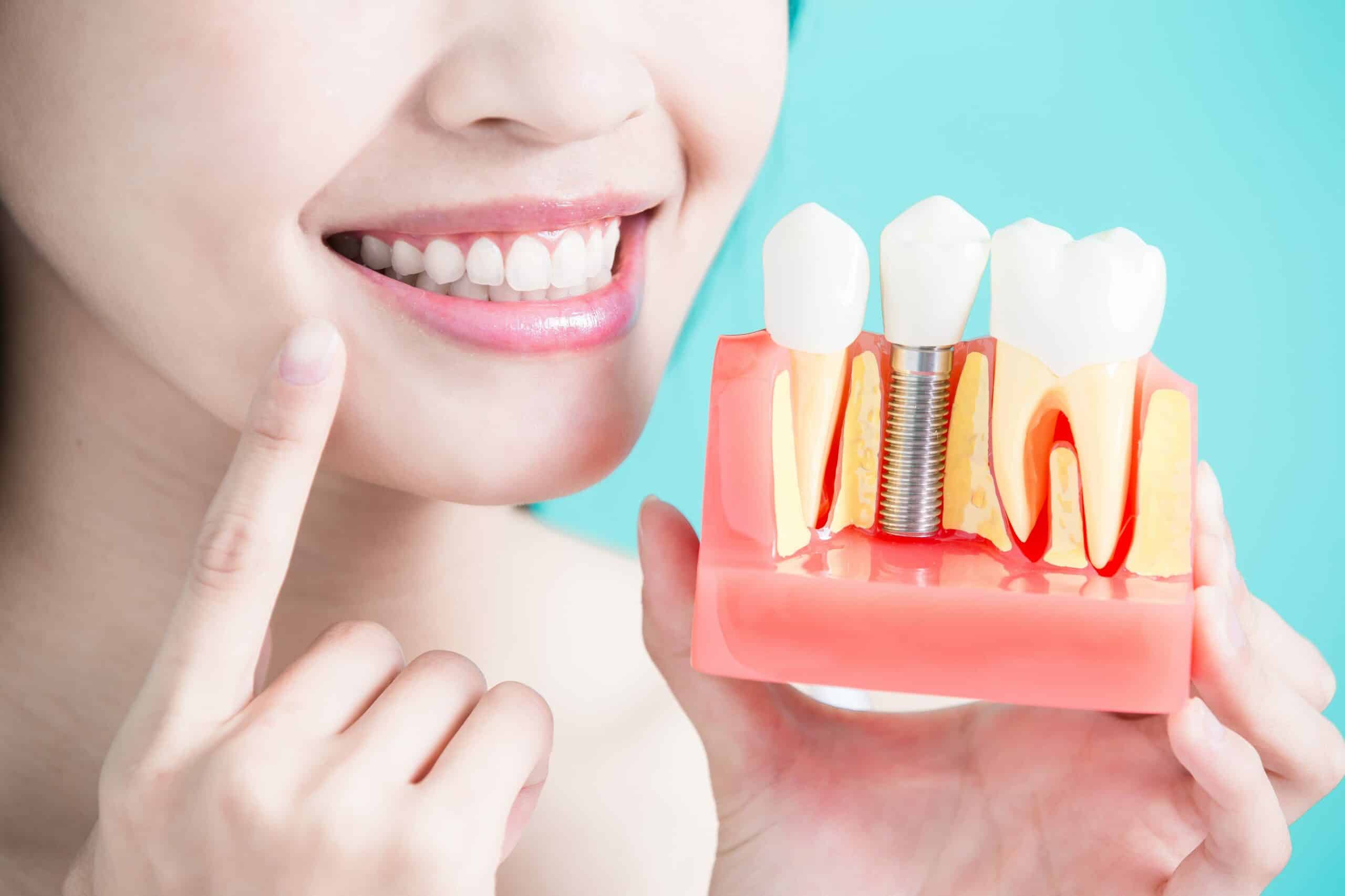 Dental Implant Image - Preferred Dental