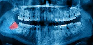 X Ray Image - Preferred Dental